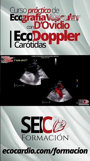 Curso Práctico de Ecografía Vascular - Eco Doppler Carótidas
