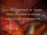 Laparoscopic Right Hemicolectomy • Video • MEDtube.net