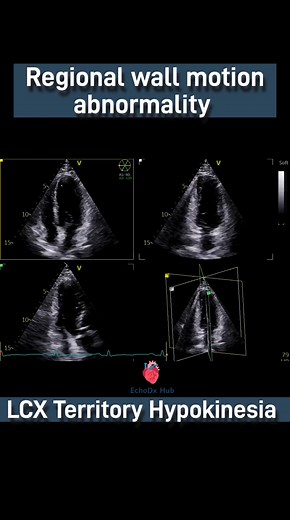 6.7K views · 100 reactions | 變 LCX Territory – Hypokinesia on...