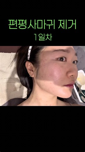 편평사마귀 제거 1일차 후기