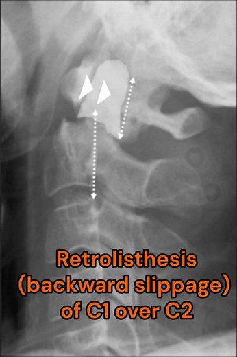 Odontoid peg fracture with retrolisthesis of C1