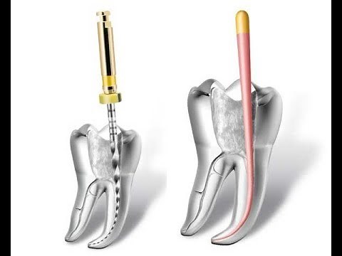Endodontic or Root Canal Instrument Tray Setup with Post Treatment Instructions For Patients