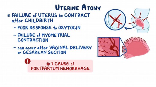 Video: Uterine atony: Clinical sciences - Video Explanation! | Osmosis | Osmosis