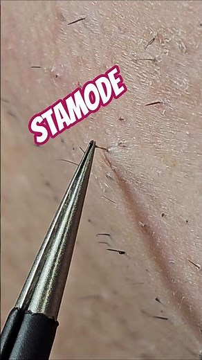 That One Hair — You’ll Feel This Pull 😬 #beard #tweezing #removal