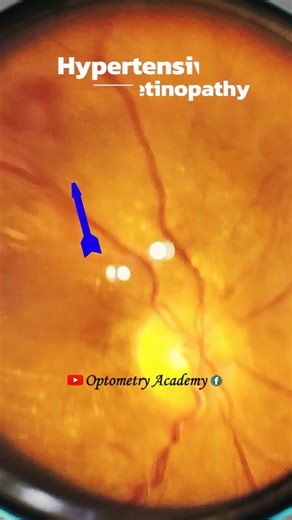 Haemorrhage | Smartphone Fundus Videography | Fundus Photography | Short Video 492