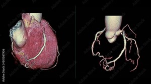 CTA Coronary artery 3D rendering image compare heart 3D and Coronary artery 3D turn around on the screen for diagnosis of vessel coronary artery stenosis .