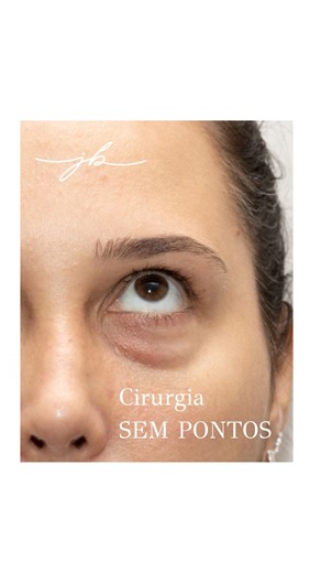 Dra. Juliana Senna F. Barbi on Instagram: "🇧🇷BLEFAROPLASTIA INFERIOR SEM CORTES VISÍVEIS E SEM PONTOS: Via Transconjuntival. É comum com a idade, bolsas de gordura começarem a se tornar visíveis nas pálpebras inferiores. Isto gera um olhar “cansado”, mesmo quando o paciente está descansado. A questão é que nem sempre isso ocorre em pacientes idosos. Pode ocorrer em jovens, embora menos frequentemente, por questões genéticas. Neste caso, como a paciente era jovem e não tinha excesso de pele nas