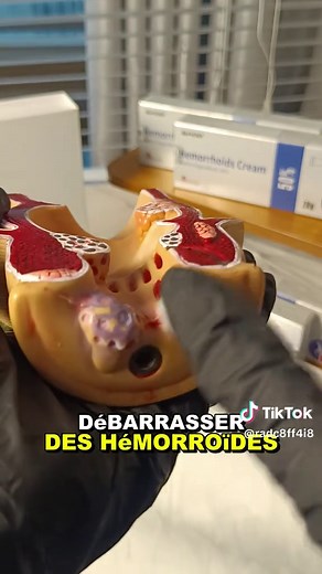 Soulagement Naturel pour Hemorroïdes