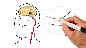 What is a stroke? A ischaemic stroke occurs when a blockage (usually a blood clot) restricts or cuts off blood flow to the brain tissue. A haemorrchagic stroke occurs when an artery in the brain busts, causing blood to leak into the surrounding brain tissue or layers. A TIA is like a stroke, except that the signs last for a short amount of time and no longer than 24 hours, and show no damage on brain imaging. A TIA is still very serious. Read more about treatment, effects and prevention methods 