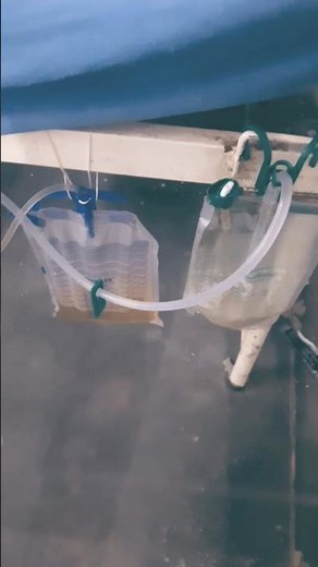 #how to ICD is " Implantable Cardioverter-Defibrillator