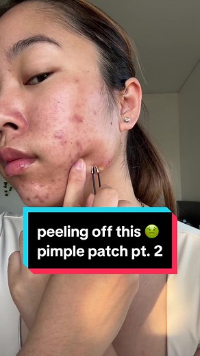 Juicy Pimple Patch Peel | Acne Skincare | Satisfying Pimple Removal