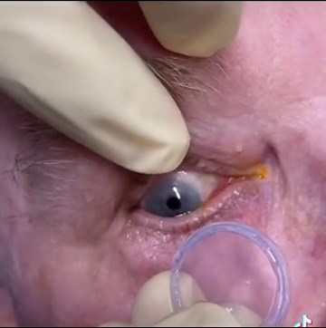 Prokera- a dry eye treatment #prokera #dryeye #dryeyetreatment #dryeyedisease