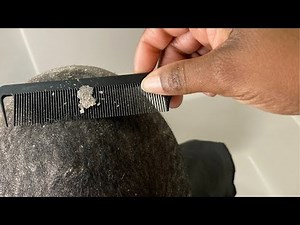 The Dandruff flakes are OUT!!!!!