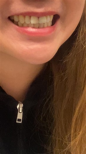 Thank you Canadian Dental Care Plan Done Dental Crown … #followersreelsfypシ゚viralシfypシ゚viralシalシ #contentmonetizationbetatools #communitysupport #highlight | Chloe Matthew