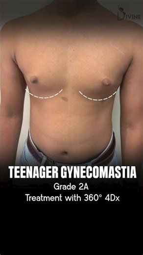 Teen Manboobs Transformation | Grade 2A Gynecomastia Surgery