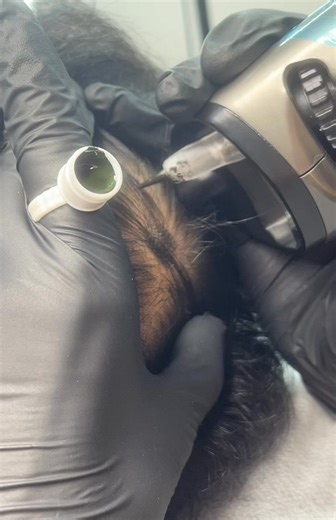 Crown Area SMP Procedure Using SCATTER Device #SMP #ScalpMicropigmentation #MensSMP #SMPProcess #ScalpArt #SCATTERDevice | Daniel Lee | Facebook