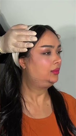 Watch this beautiful face transformation Discover how advanced double chin treatment