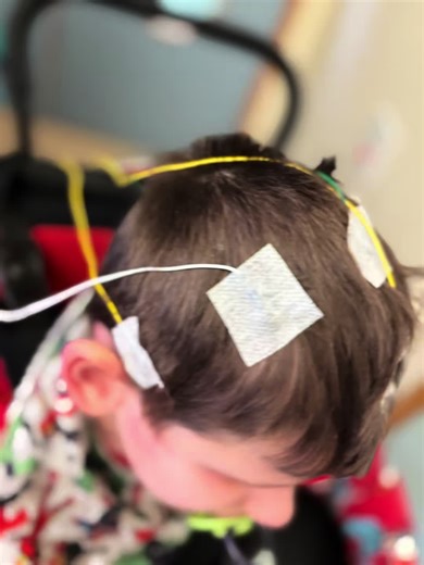 Taylor's EEG Journey: A Path to Epilepsy Surgery