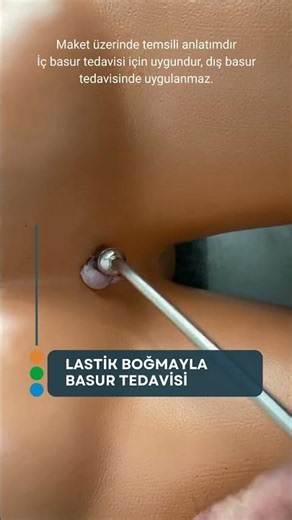 BASUR TEDAVİSİNDE LASTİK BOĞMA YÖNTEMİ #hemoroid #lazerlehemoroidtedavisi #basur