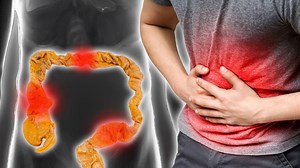 How To Prevent Colon Cancer