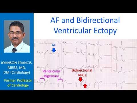 AF and Bidirectional Ventricular Ectopy