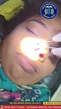 nasal polyp treatment without surgery #dr.baljinder goniana mandi