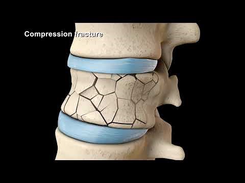 vertebroplasty and kyphoplasty
