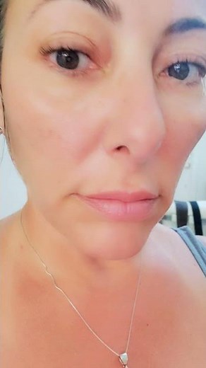 Laser Procedure to change your brown eyes gray blue - Irex Laser