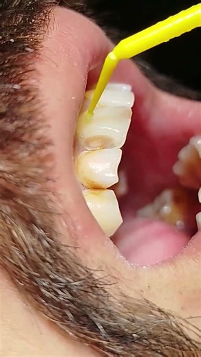 bonding agent application #dental #shorts