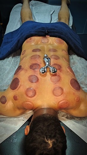 VIP Cupping 🔥 #cuppingtherapy #asmr #cupping #hijama #massage#painrehab#cupcure#viral#reels#shorts