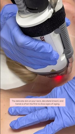Fraxel Neck & Chest Anti-Aging Laser Treatment