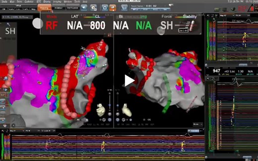 High-density mapping with RFA to assess epicardial connections in PFA era: a real paradigm Over the past 20 years, we have continuously refined point-by-point radiofrequency (RF) ablation for atrial… | Alberto Alfie