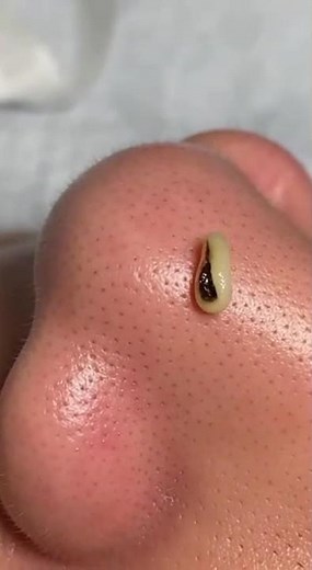 Nose Blackhead Extraction 😱 | Most Satisfying Pimple Removal Ever