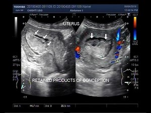 Ultrasound Video showing retained Products of conception inside the uterine cavity.