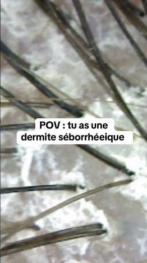 Voici à quoi ressemble une dermite Seborheique #cheveux #haircare #scalpcare #dermatology
