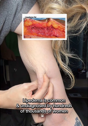 Lipedema vs normal fat. Lipedema is a disease. #lipedema #fat #connectivetissuedisorder #fibrosis
