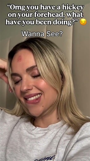 Shocking Forehead Hickey Has Everyone Asking The Same Question