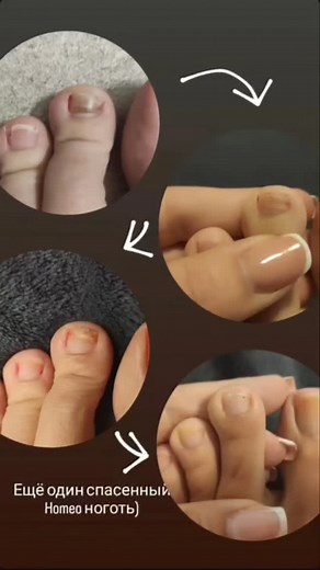 С заботой о Вас, HOMEO - гомеопатический комплекс от грибка ногтей и кожи, более 2500 довольных клиентов! Отзывы с фото в актуальных историях   300грн=770р=8€ доставка по всему миру  +380660426445 Вайбер / Ватсапп Наталья | Лечение грибка ногтей и кожи | Facebook