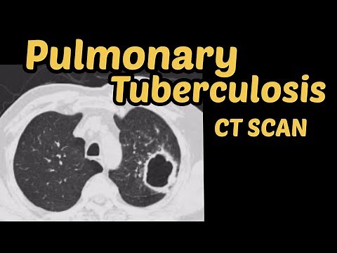 Pulmonary Tuberculosis | CT Scan Chest | Radiology
