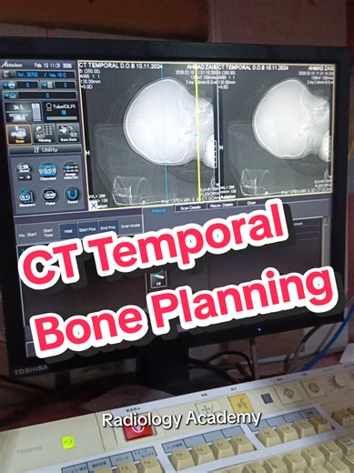 CT Temporal Bone Planning in Radiology