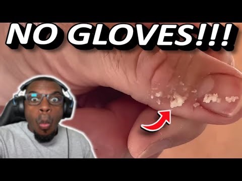 Pimple Popping with No GLOVES ON?! | Popping huge blackheads and Pimple Popping