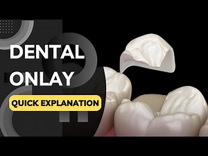 What is a Dental Onlay? Quickly Explained in a Few Seconds!