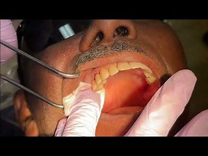 Tooth Extraction & Dental Bone Graft - Physics Forceps, Osteogen Plug & Dental Suture