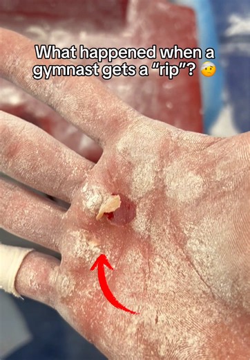 What happens when you rip your hand 🤔 #gymnastics #olympics #olympic #medical #sports