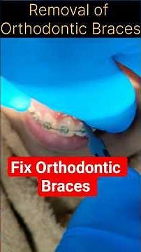 Removal of Fix Orthodontic Braces # Fix Pin Removal # Metal Braces # Fix Orthodontic Braces