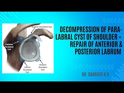 DECOMPRESSION OF ANTERIOR PARALABRAL CYST OF SHOULDER AND REPAIR OF ANTERIOR & POSTERIOR LABRUM
