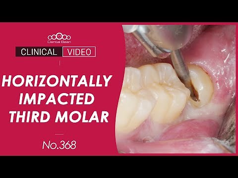 Extraction of the horizontally impacted left mandibular third molar [Dr. Cho Yongseok]