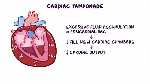Video: Cardiac tamponade: Clinical sciences - Video Explanation! | Osmosis | Osmosis