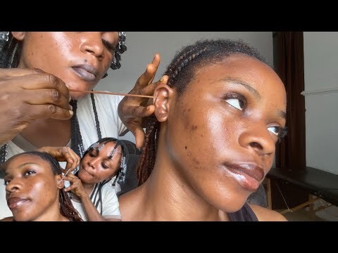 ASMR Aggressive Ear Cleaning Tingles, Pimples Popping And Head Massage