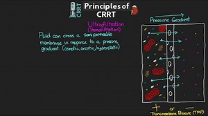 【卡卡】3、Principles of CRRT Therapy - CRRT Explained!